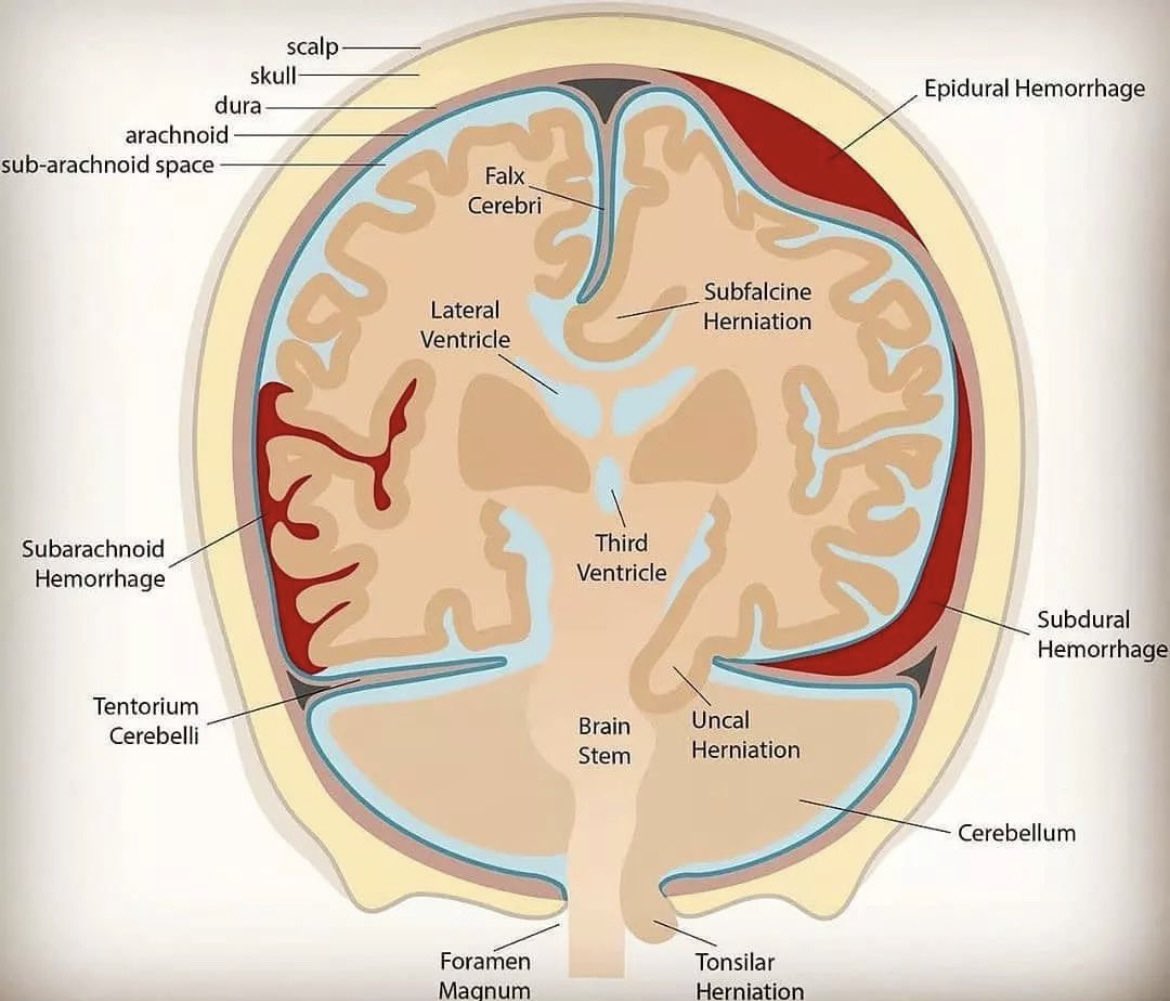 Patterns of Brain Bleeds