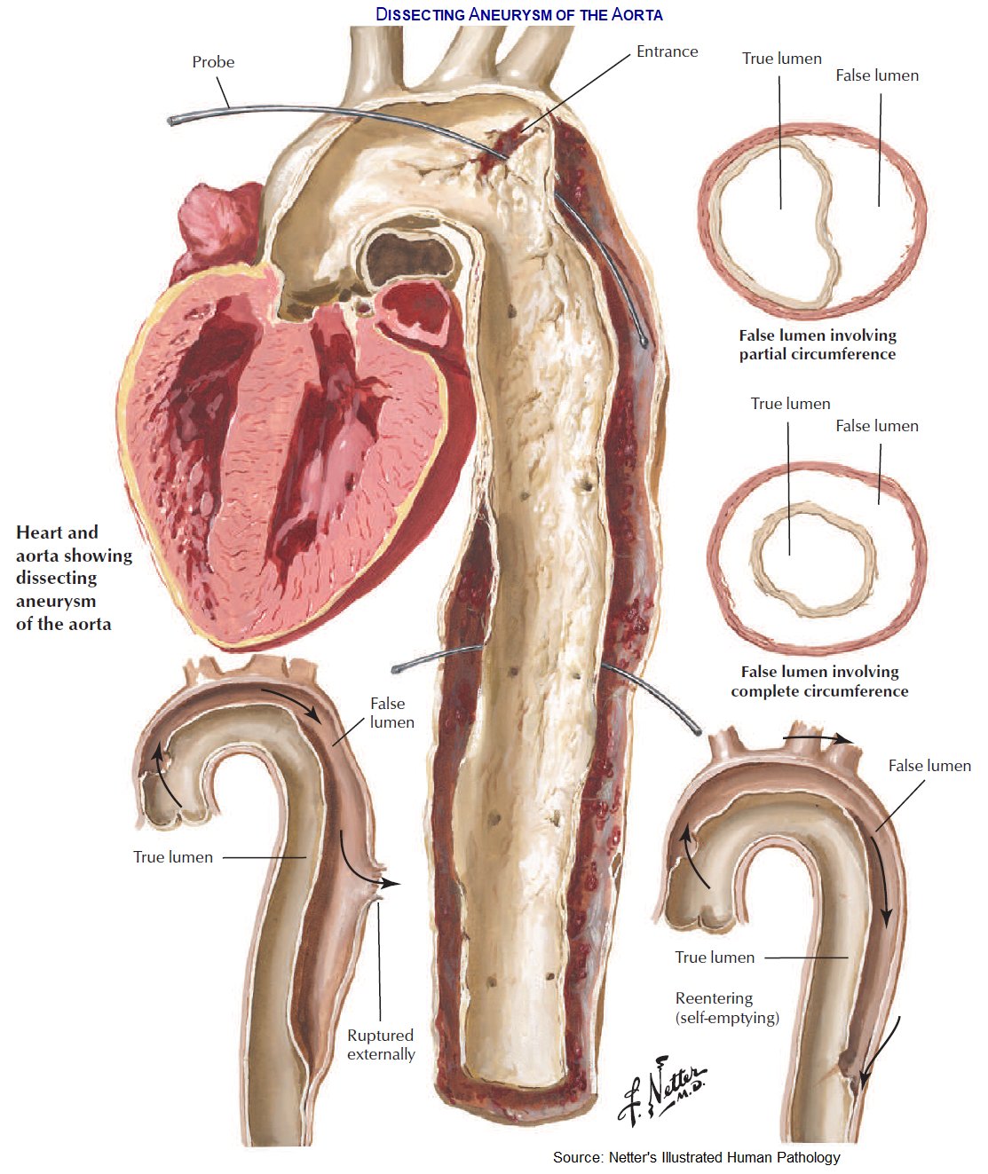 Aortic Dissection Pathology