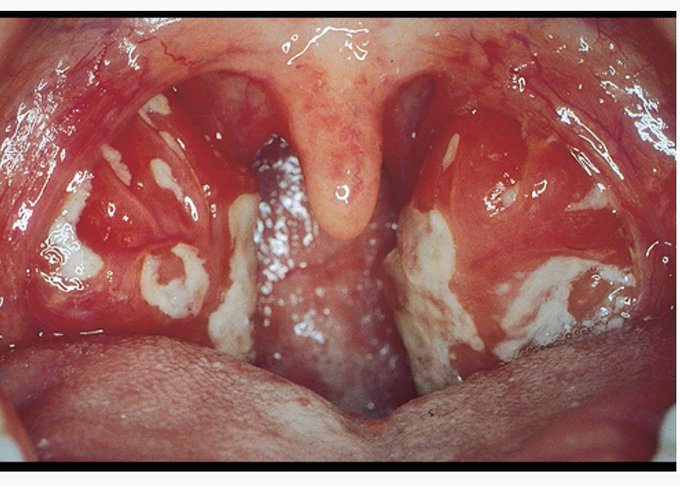 Infectious Mononucleosis Image