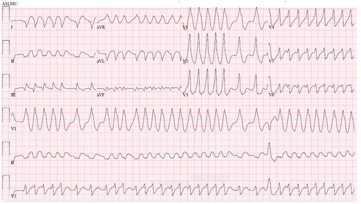 ECG AF WPW 122