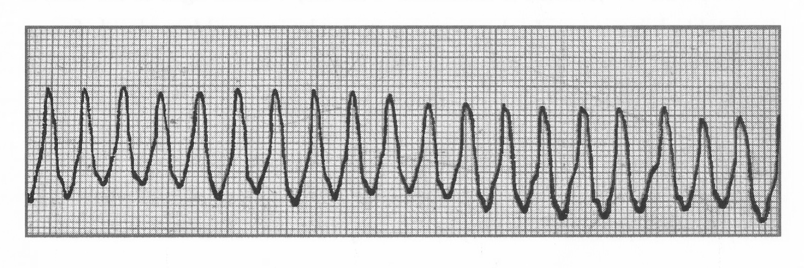 ECG VT 201