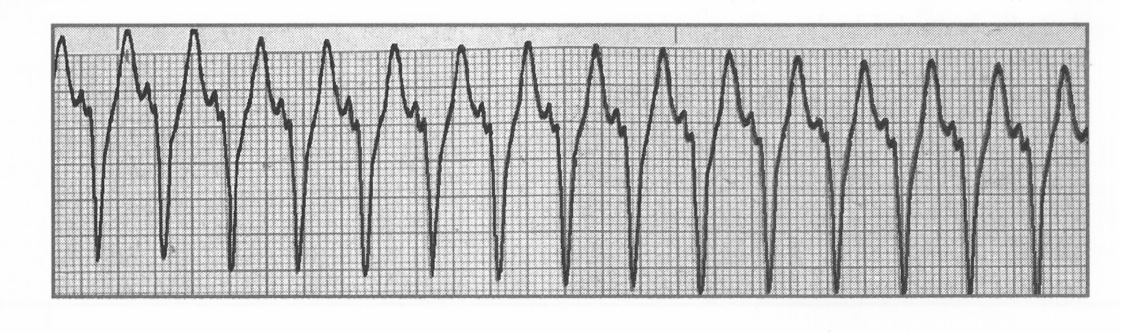 ECG VT 202