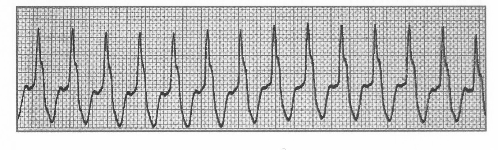 ECG VT 203