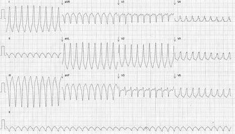 ECG WPW PSVT 1