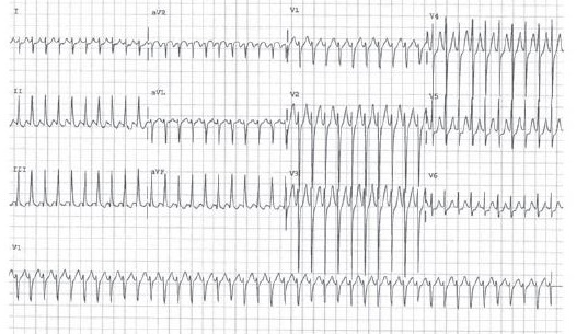 ECG WPW PSVT 34