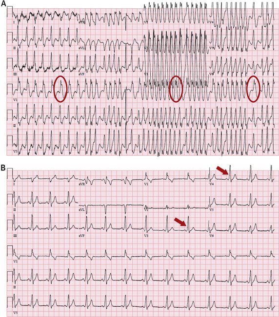 ECG WPW AF 43