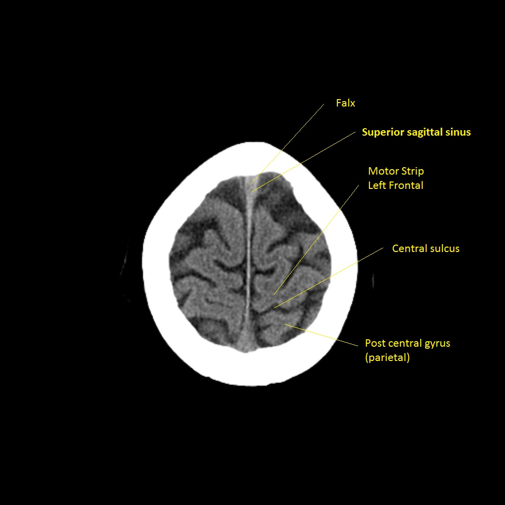 CT brain slice