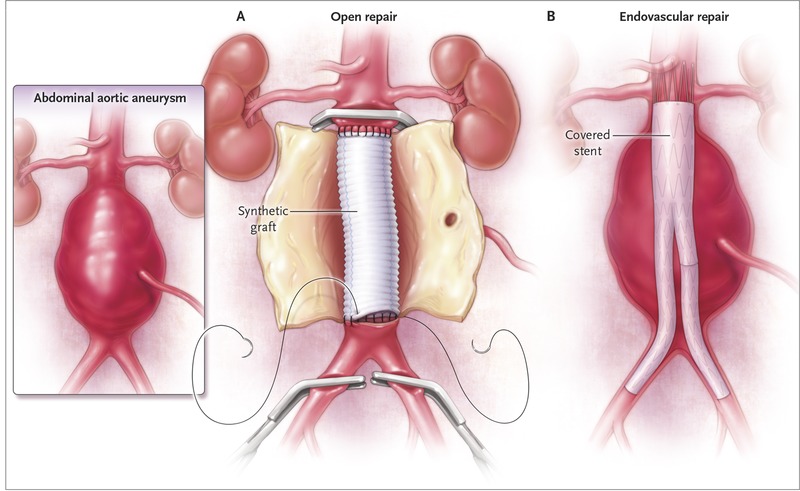 Abdominal Aortic Aneurysm diagram