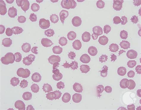 Acanthocytes