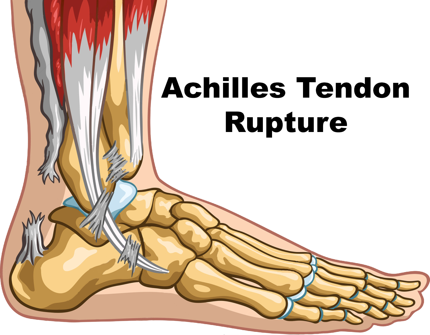 Achilles tendon image