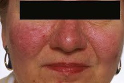 Acne Rosacea Image 1