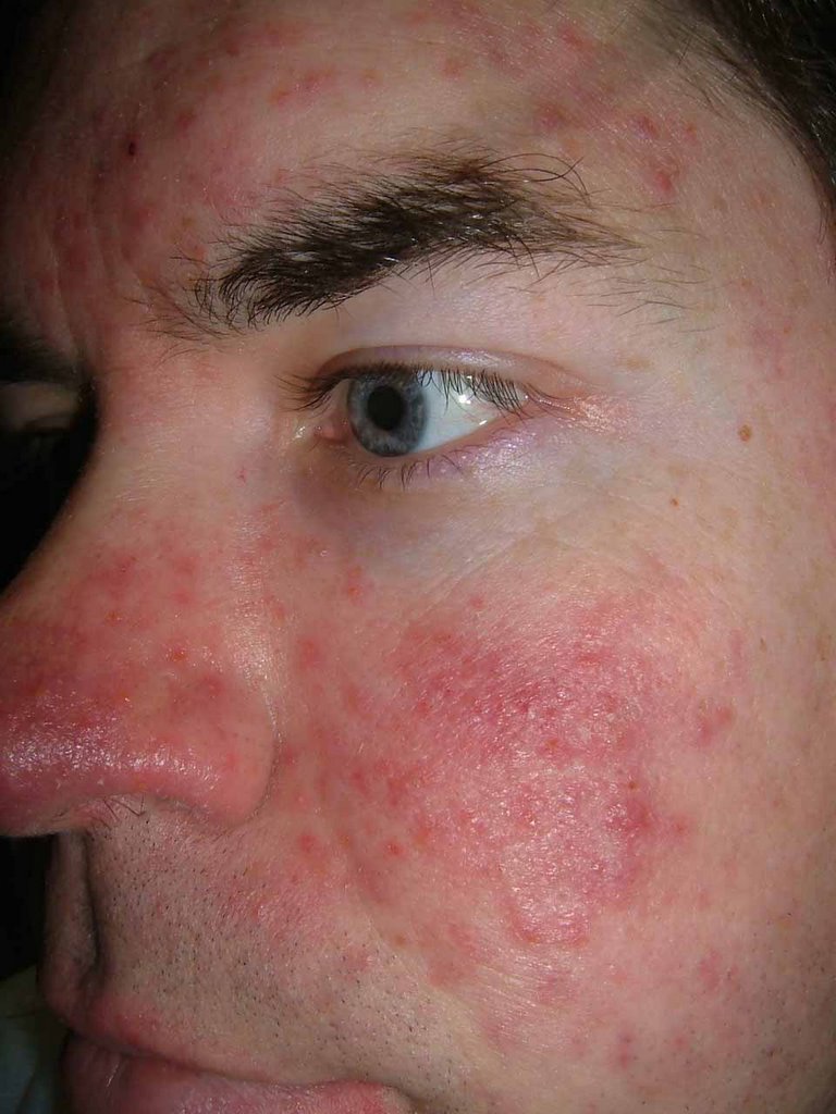 Acne Rosacea Image 2