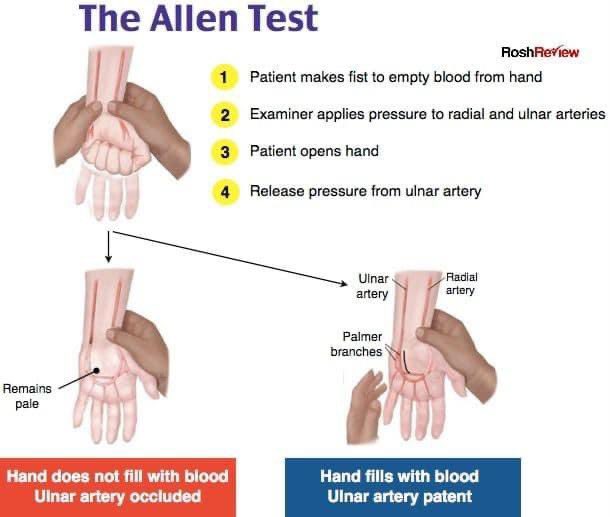 Allen Test