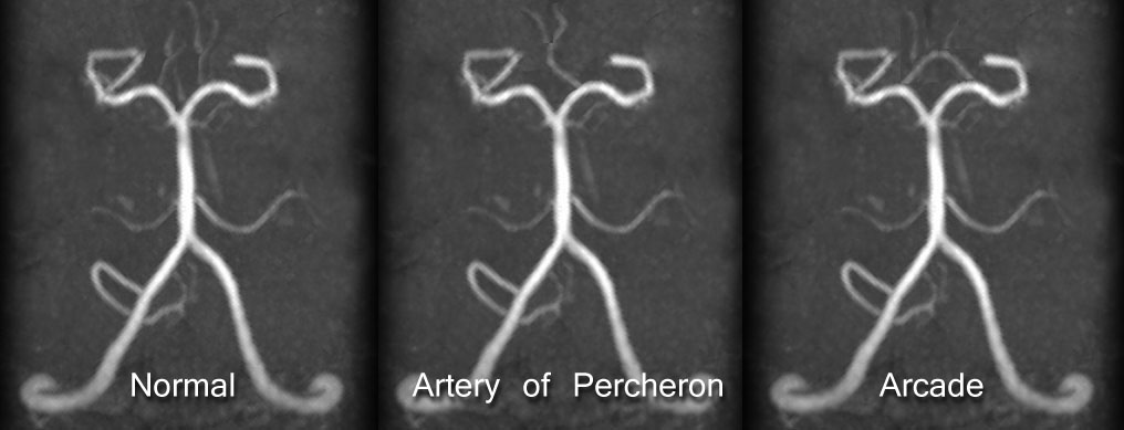 Artery of Percheron Image 2