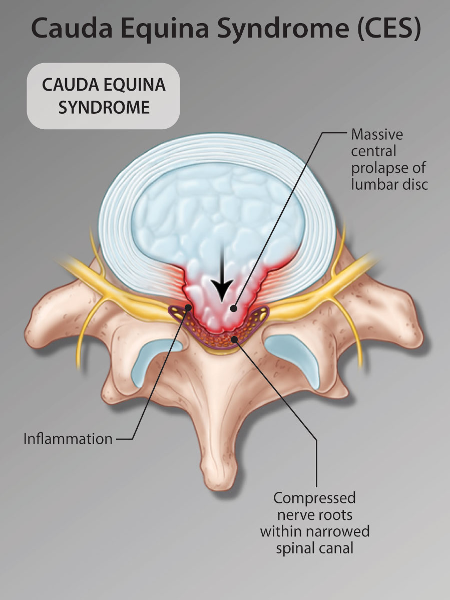 Central Disc Compression of Cauda Equina