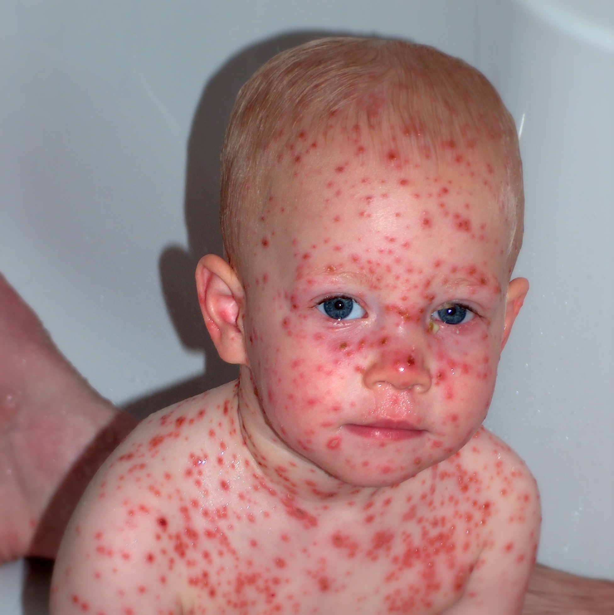 Chickenpox rash