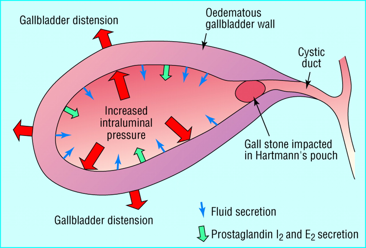 Cholecystitis Image