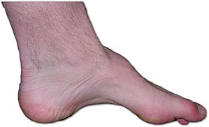 Foot showing signs of Charcot-Marie-Tooth disease