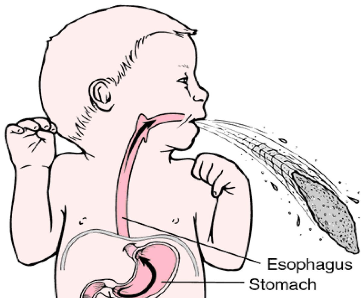 Hypertrophic Pyloric Stenosis