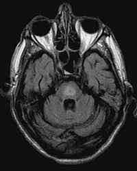 Central Pontine Myelinosis