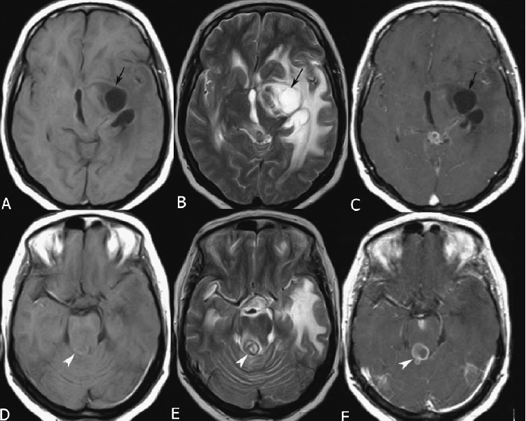 Cryptococcal abscess