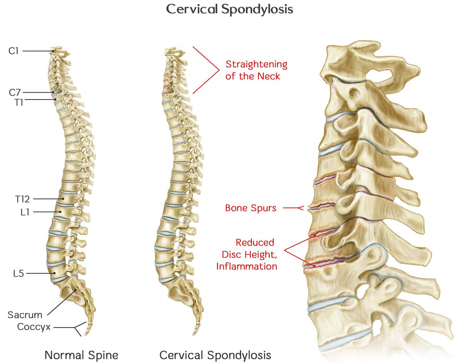 Cervical Spondylosis MRI Image