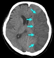 CVA Infarct on CT