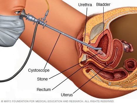 Cystoscopy Procedure