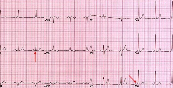 ECG WPW