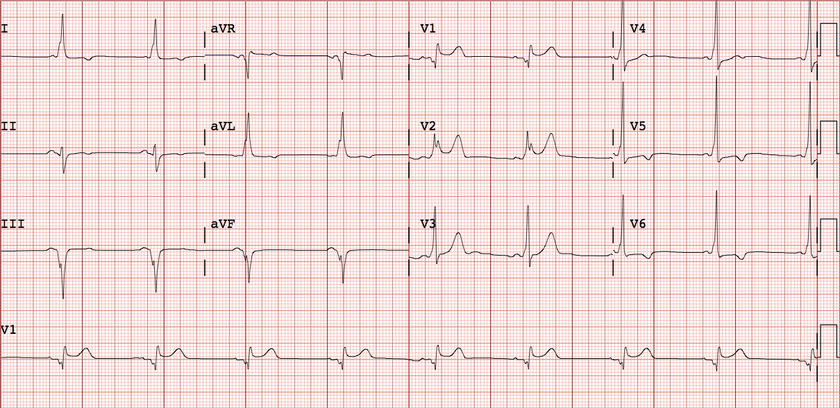 ECG WPW 14