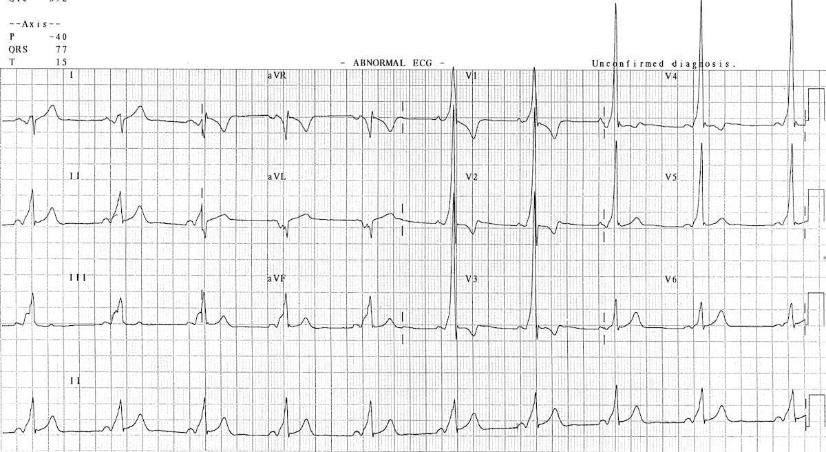 ECG WPW 17