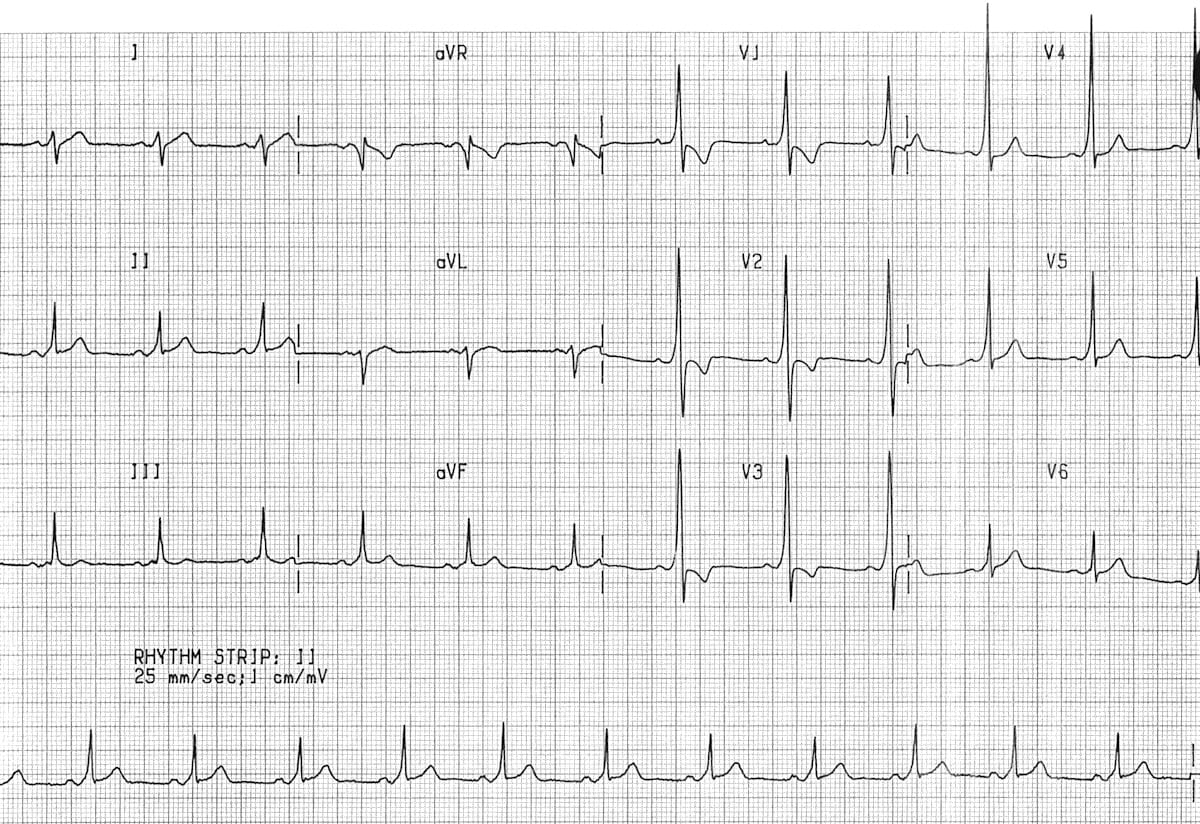 ECG WPW A23