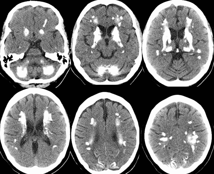 Fahr Syndrome Imaging