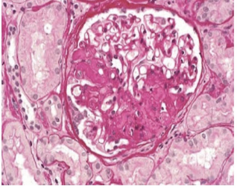 Microscopic image showing segmental sclerosis in glomeruli, characteristic of FSGS.