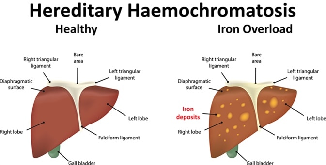 Haemochromatosis Genetics