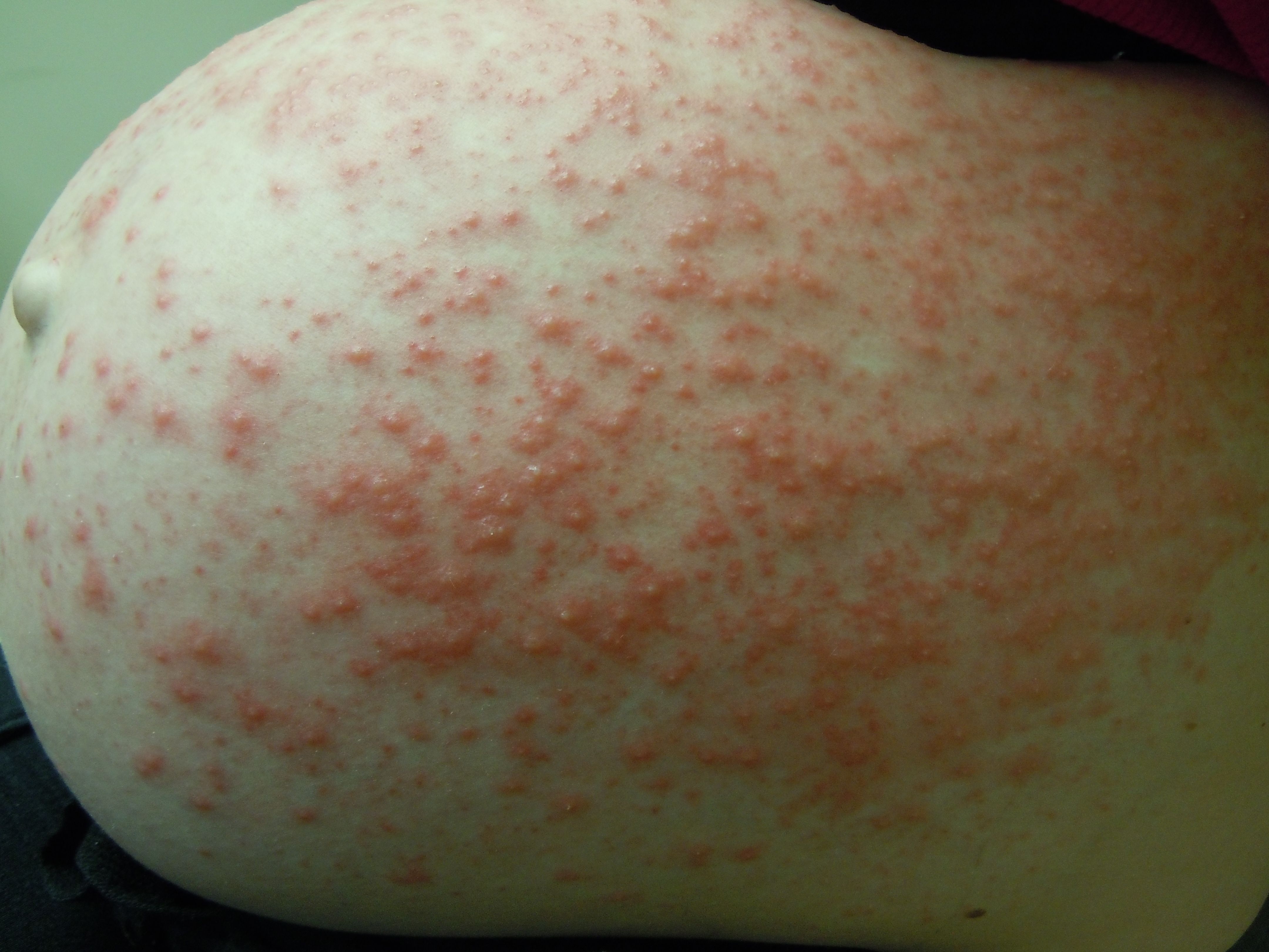 Herpes Gestationis Rash Image