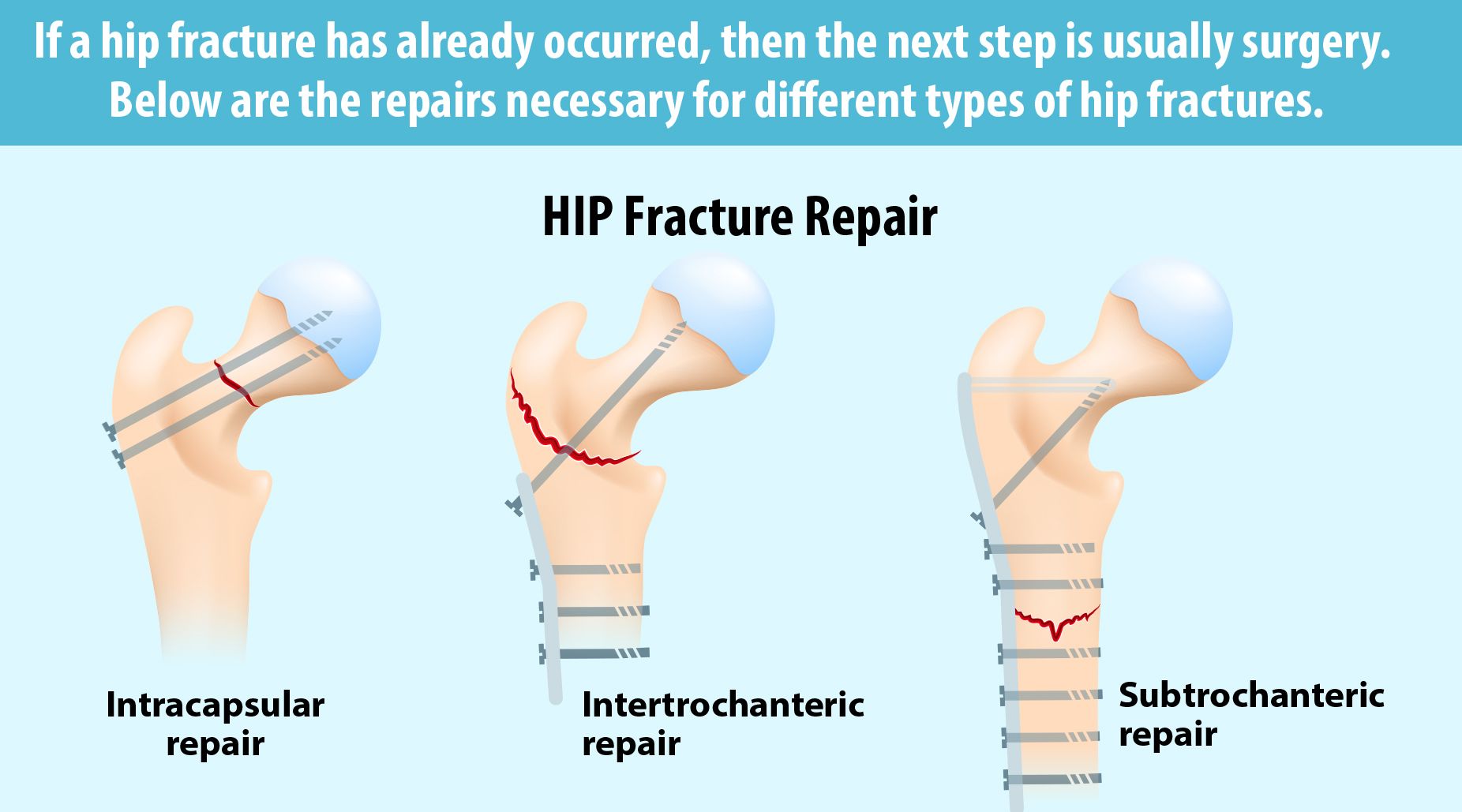 Hip Fracture Treatment