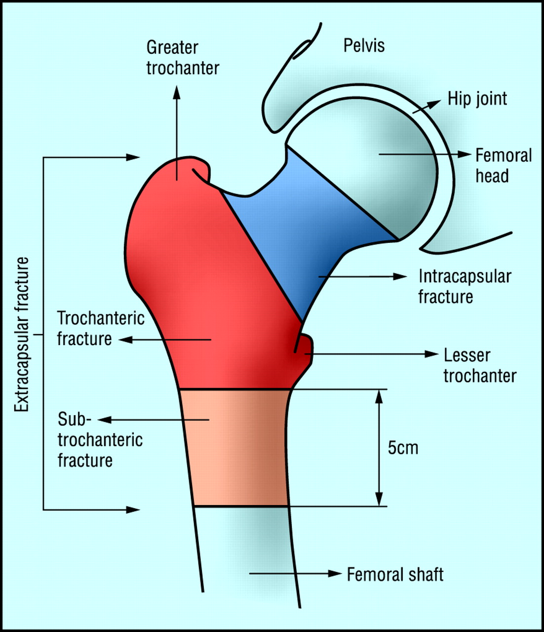 Hip Fracture Anatomy Diagram