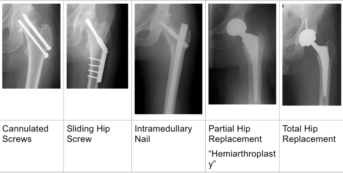 Hip Fracture Surgical Options