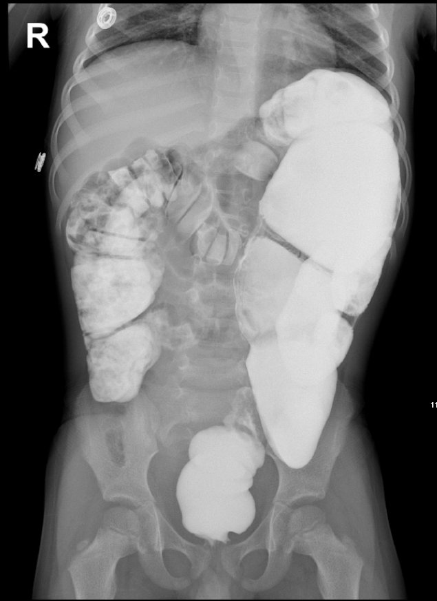 Hirschsprung's Disease