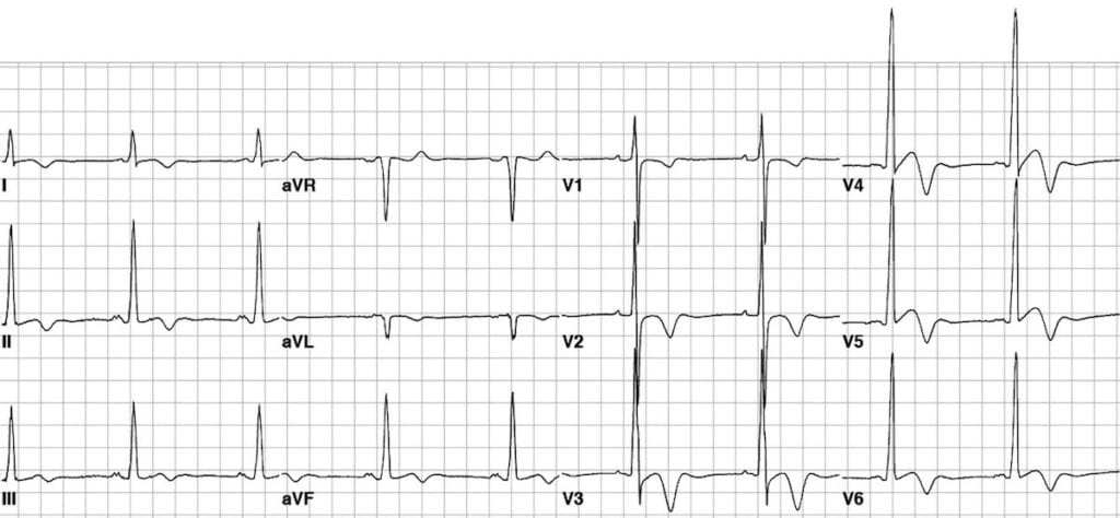 ECG of a patient with HCM