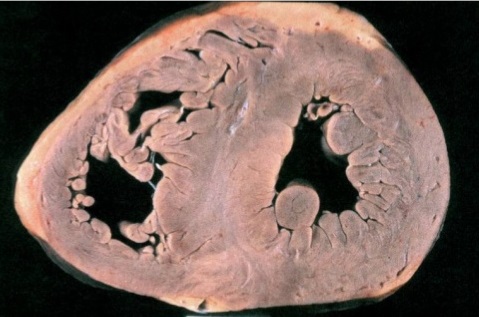 Septal Hypertrophy in HCM