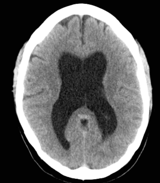 Hydrocephalus Image