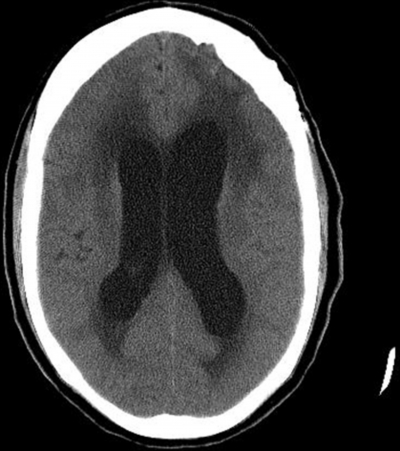 Hydrocephalus Image