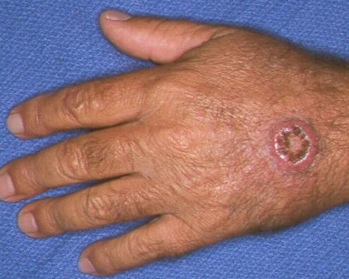 Keratoacanthoma lesion