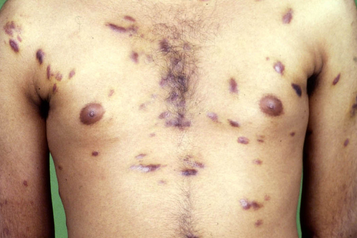 Kaposi Sarcoma image 1