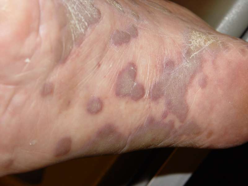 Kaposi Sarcoma image 3