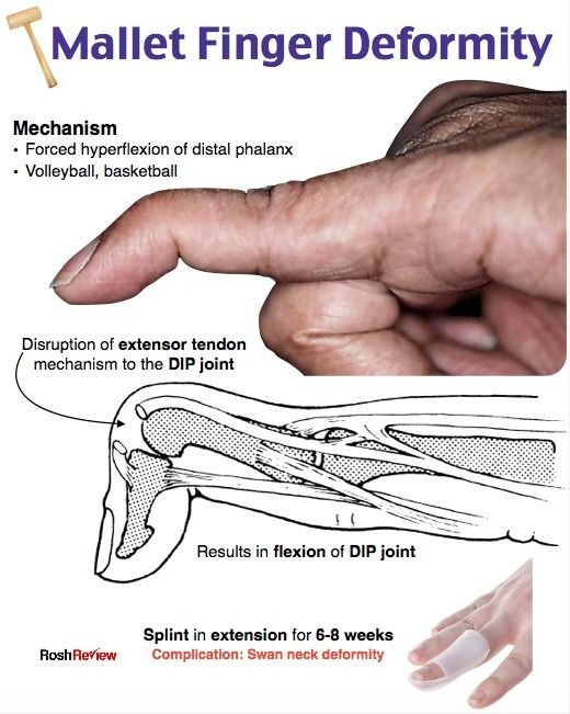 Mallet Finger Injury