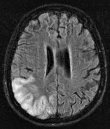 MELAS Imaging Example