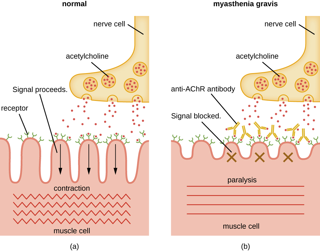 MG Pathology Image